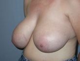 Patient # 48277 Before Photo # 3